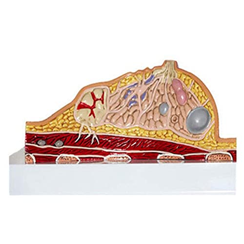Modelo anatómico La Plantilla de anatomía de la anatomía de la Mujer Muestra hiperplasia lobular lobular, Carcinoma invasivo de Pecho, quistes de Pecho, fibroadenomas y Otras patología mamaria